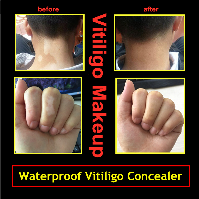Waterproof Vitiligo Face Concealer Pen For Covering Hands Body Leukasmus White Spots Hide Skin Leukoderma Instant Makeup Liquid Pen 2pcs/lot от DHgate WW