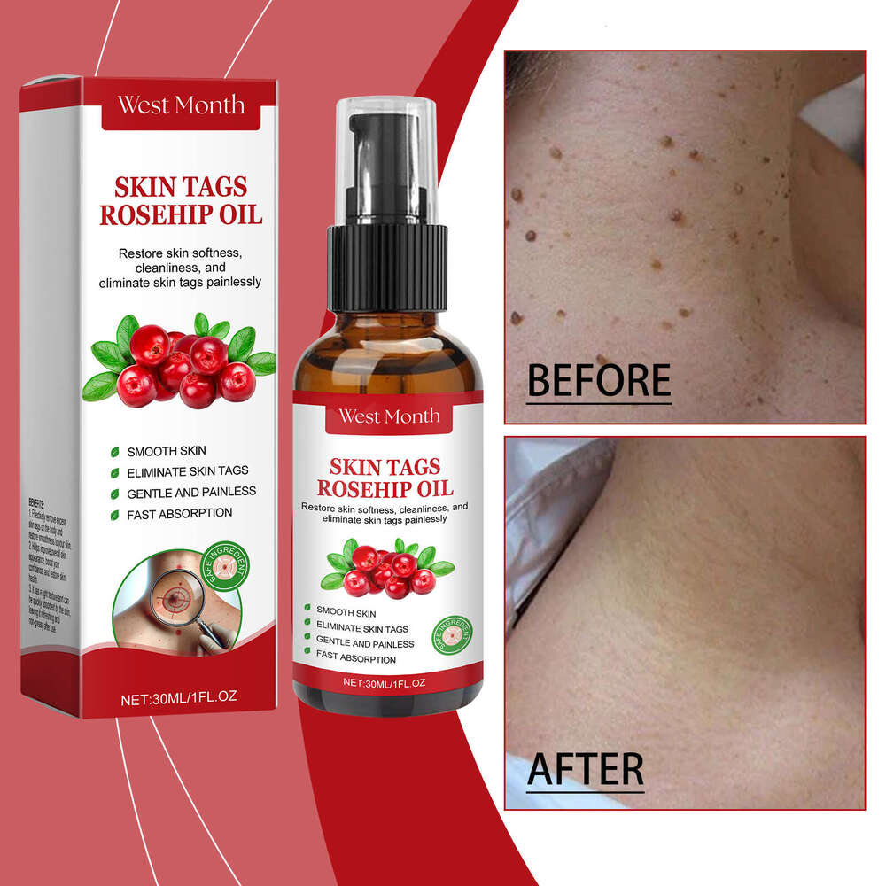 West Month Rosehip Seed Wart Essence Oil Lightens Pimples Moisturizes Repairs Smooths Skin S260131
