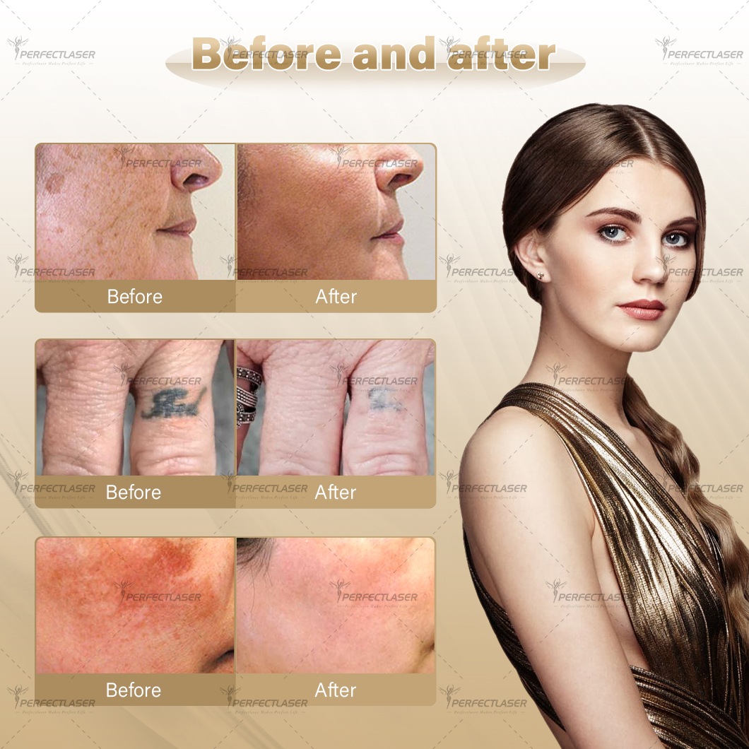 Professional Portable Nd YAG Laser Tattoo Removal Machine 532nm 755nm 1064nm 1320nm 5 Probes Carbon Peeling Pigmentation Beauty Salon Equipment Factor