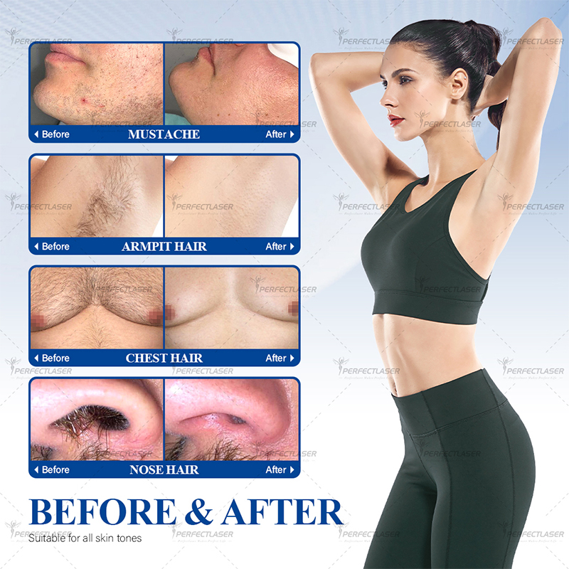 High Power OEM Hair Removal device Professional Grade Laser Hair Removal Machine Big Spot Size 100 Million 1600W User Friendly Android Interface Beaut