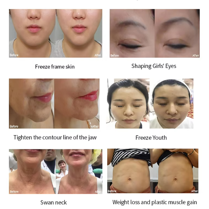Latest Hifu High Intensity Focused Ultrasound 2 in 1 MFU and RF Portable HIFU 7D Lift And Tightening Wrinkle Remover Skin Tightening Machine