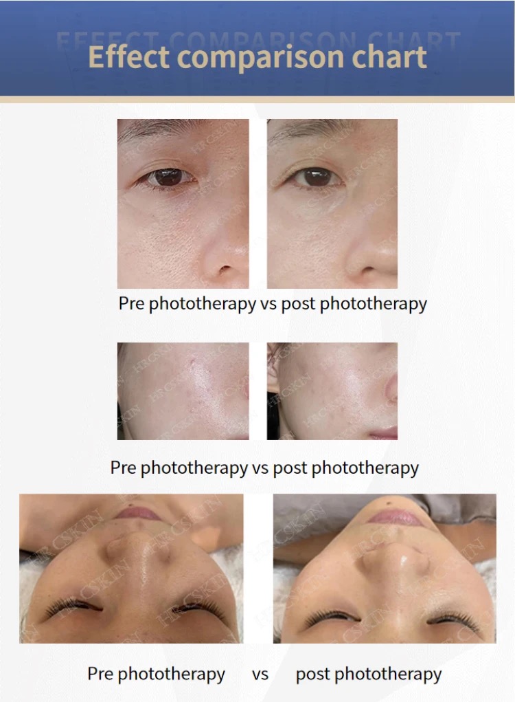 UV Lights PDT Acne LED Facial Care AntiAging Collagen Hydro oxygen spray mask aqua peel O2toDerm LED Dome oxygen Machine