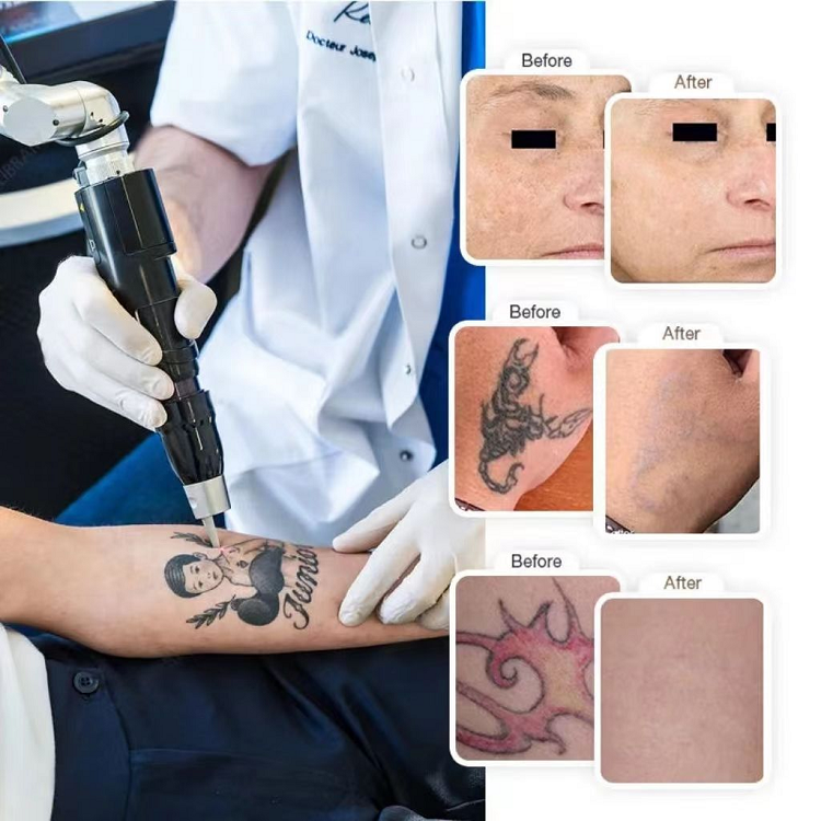 Stationary 1064 532 755 Pico Laser Tattoo Removal Yag Picosecond Laser Machine For Pigment Removal