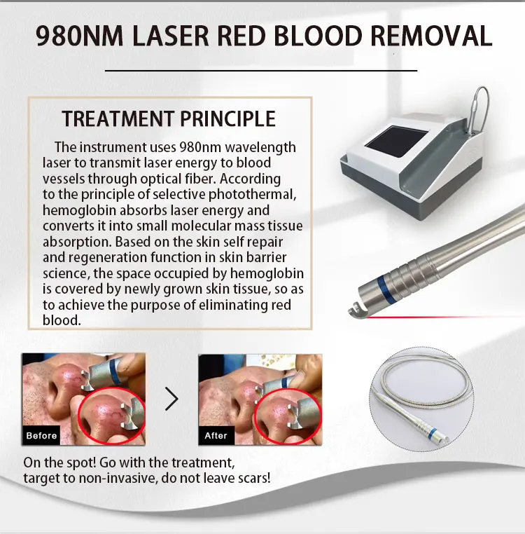 Professional Painless Vascular Therapy 980Nm Diode Laser Red Blook Silk Spider Vein Remove Treatment For Pigment Lesion Broken Vein