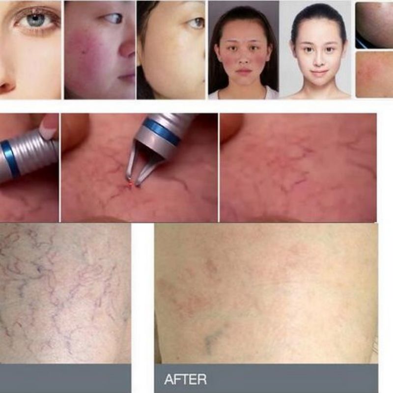 laser nail fungus therapy device/ laser Vascular Removal Machine 980nm diode laser spider veins removal