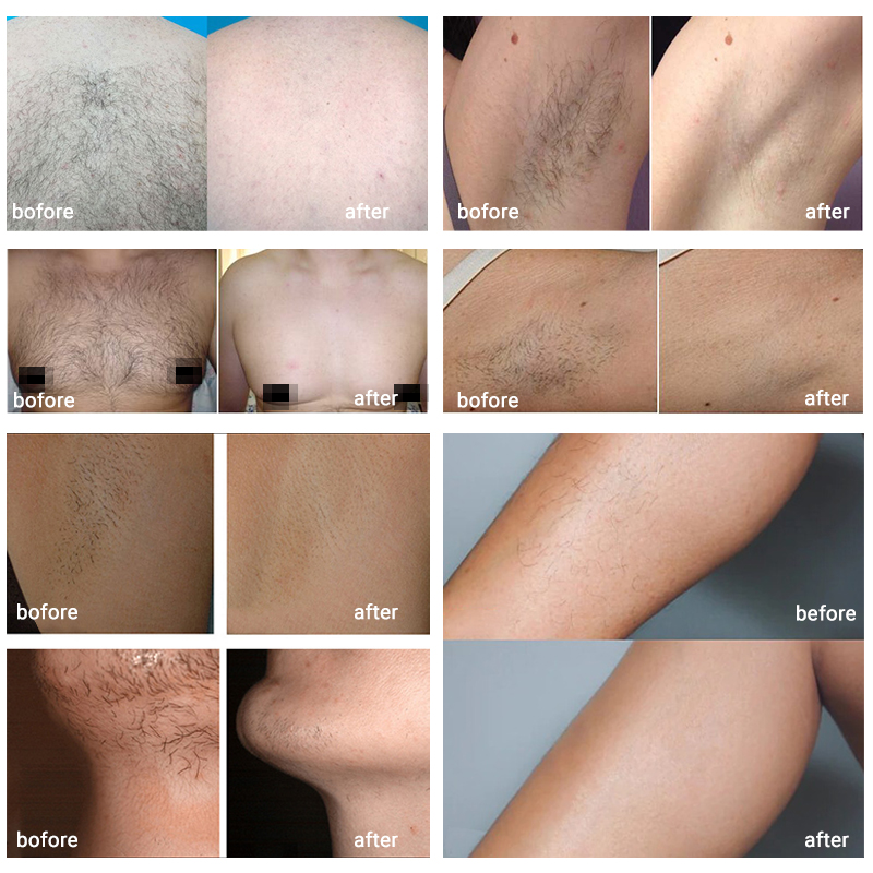 New Android System Diode Laser 808nm 755 1064 940nm laser Hair Removal Machine New technology non-crystal