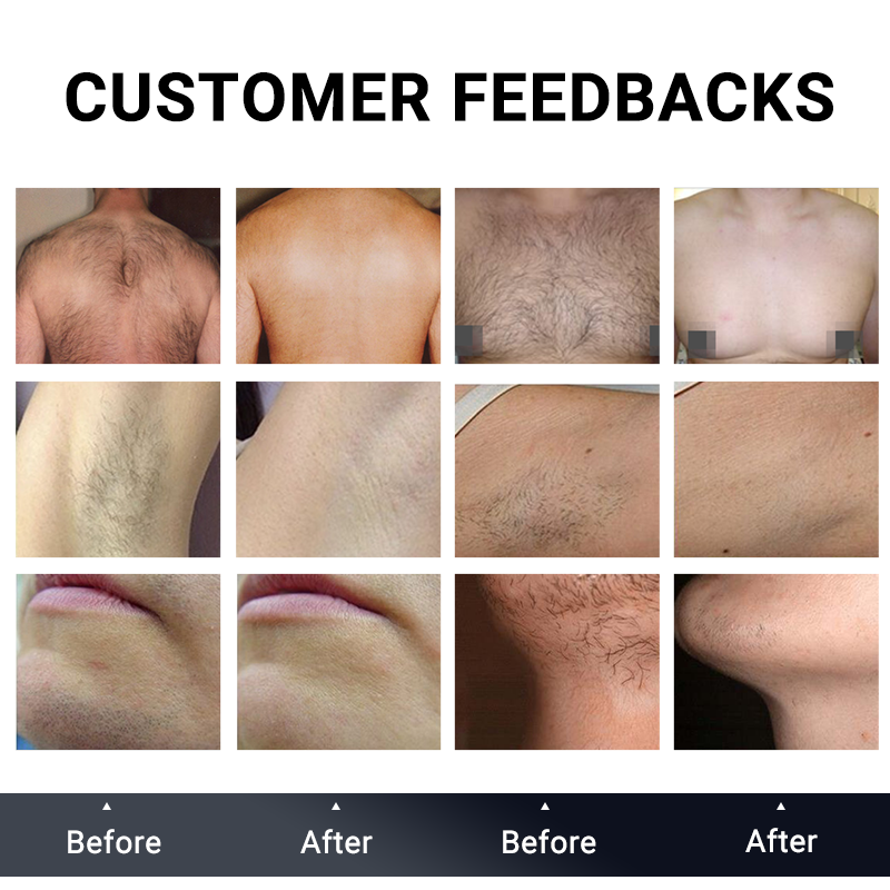 High Quality Alexandrite Laser 808nm Diode Laser Hair Removal Machine 4 wavelength