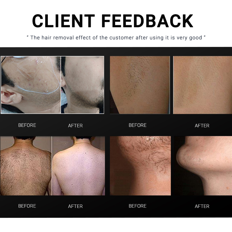 Professional newest 808nm Diode Laser Hair Removal Device with 4 Wavelengths 808nm & 940nm 1064nm 755nm 3 Yeas Warranty