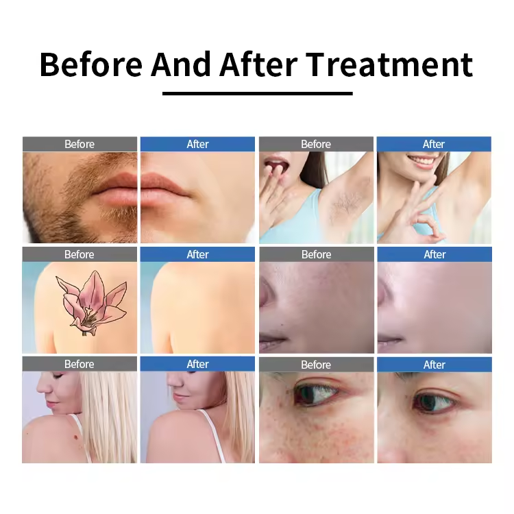 50 Million Shots Powerful 2000W Laser Diode 808 Ice Laser Hair Removal 3 Waves 755 808 1064nm Diode Laser Hair-removal Machine Picosecond Handle Optio