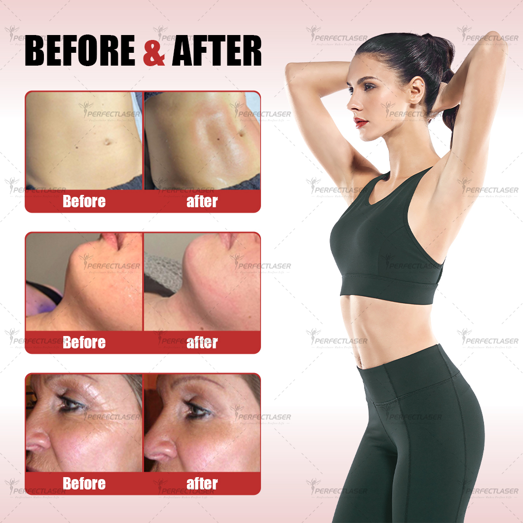 Body Face Roller slimming Machine Deep Smooth Cellulite Treatment Infrared Roller Massage Vacuum Therapy