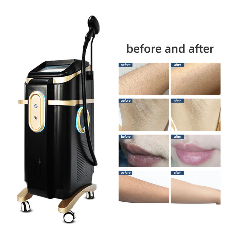 Multi-Wavelength Diode Laser Pain-free Hair Removal Full Body Freezing Painless Depilation 755 808 1064 Diode Laser Skin Rejuvenation Acne Treatment M