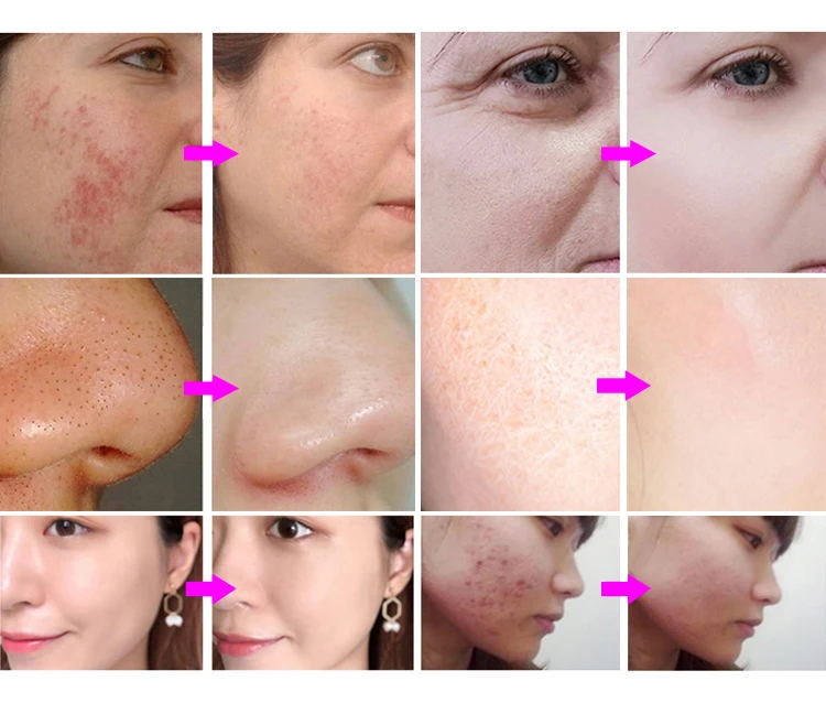 Multi-Function Skin Analyzer 8in1skin analysis New Technology microneedle plasma beauty System Instrument