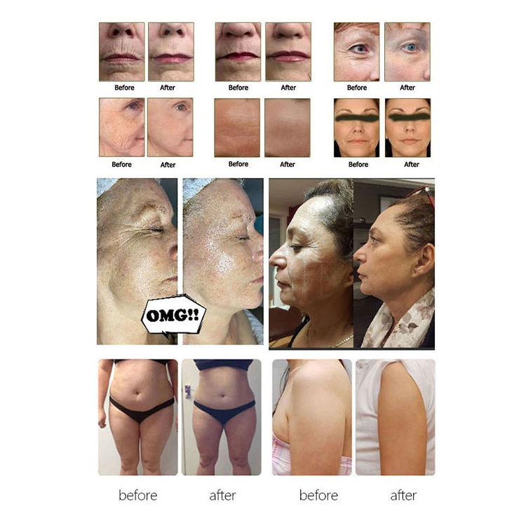 High Quality 4 in 1 Face Lifting Smas Firming Skin Care Beauty Machine ultrasonic rf skin tightening machine