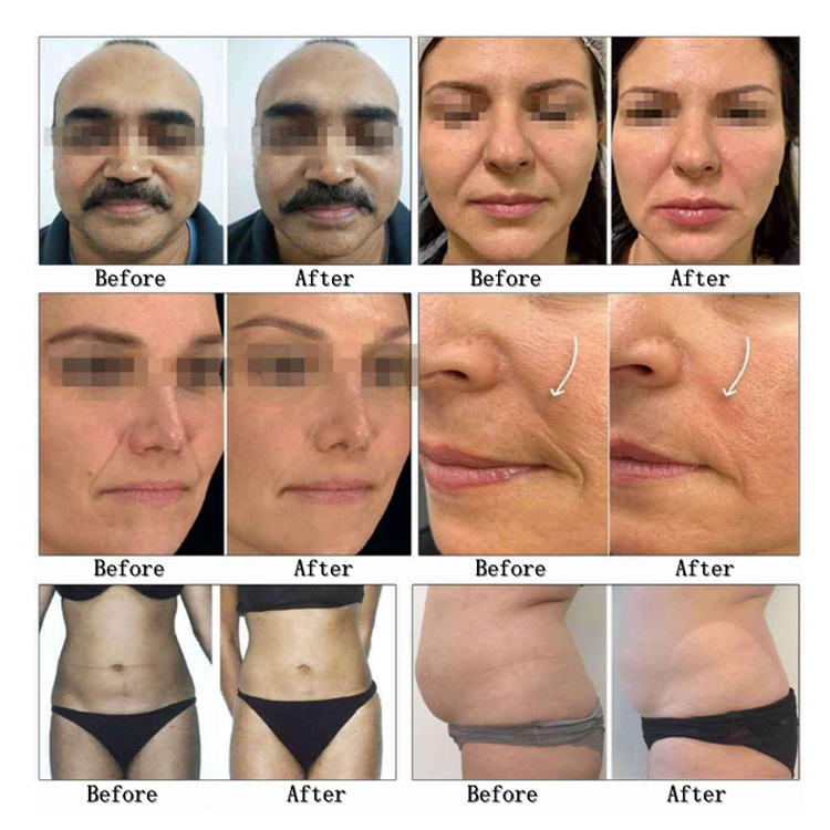 RF Wrinkle Remover Microneedle Face Lift Machine Rf Fractional Micro Needle 12d Hifu Machine