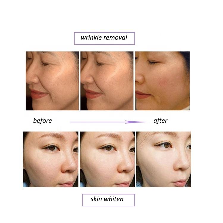 Skin Cleaning Care Maintenance Anti-aging Pdt Led Deep Moisturizing Skin Management Instrument