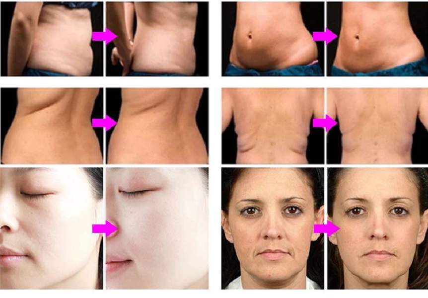 Latest updates Non-surgical ultra 360 skin tightening anti aging radio frequency Fat Reduction body slimming machine