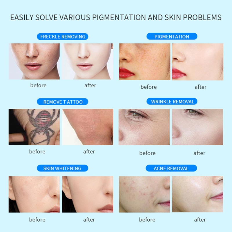 1064 755 532 Q Switched ND Yag Laser Picolaser Machine Picosecond Laser Tattoo Removal Machine Pico Laser Tattoo Remover Machine