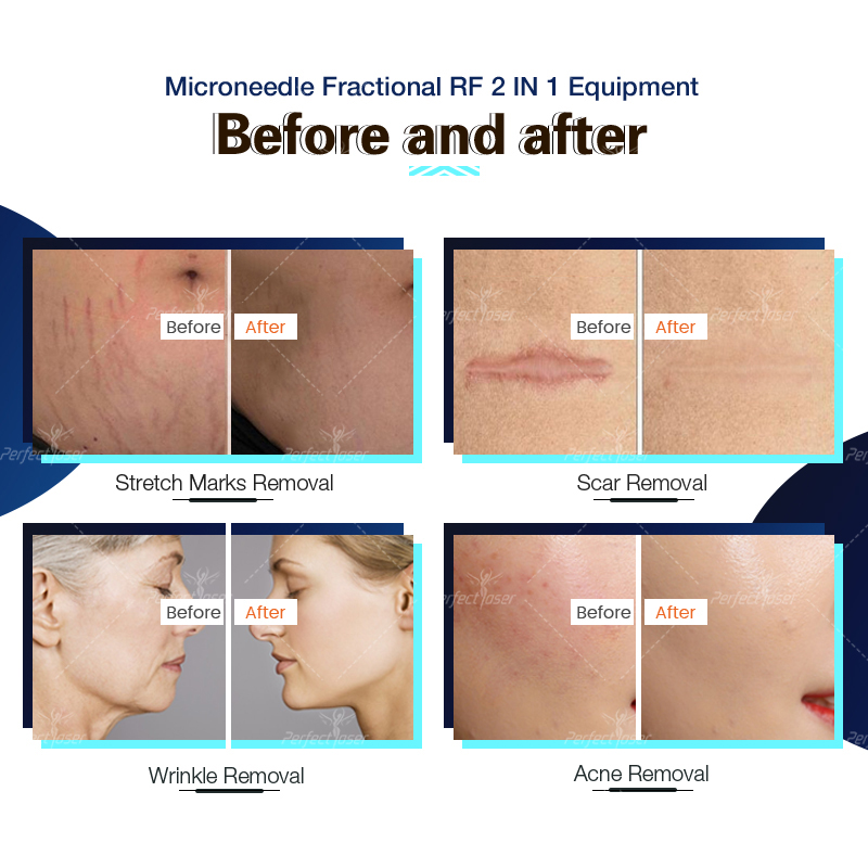 Perfectlaser Professional Fractional Rf Microneedle Machine Wrinkle Acne Scars Removal Equipment Stretch Marks Beauty Salon Use