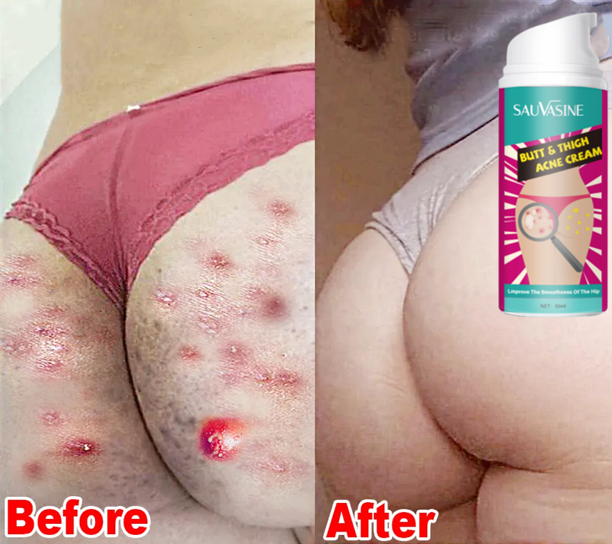 Butt Acne Clearing Spot Treatment Cream Clears Acne Pimples Zits Razor Bumps and Dark Spots for the Buttock Thigh Area