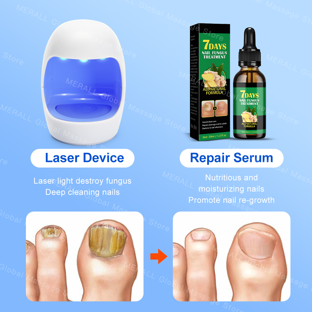 Fungal Nail Treatment Device Repair Fast Nails Fungus Onychomycosis Repair Toenail Fingernail Removes Nail Fungus Foot Care