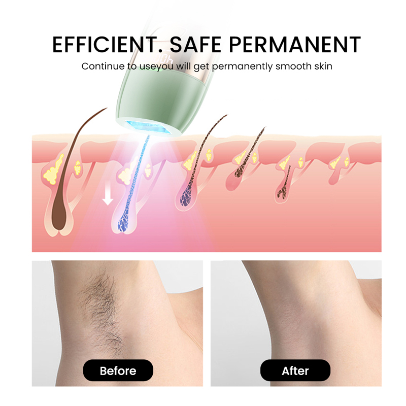 MKJS laser hair removal wireless electrolysis hair removal instrument instructions