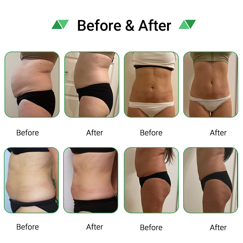 High Intensity Laser Liposuction Machine Maxlipo 10D Lipolaser Fat Loss Body Contouring Fat Burner Lipo Laser Shape System