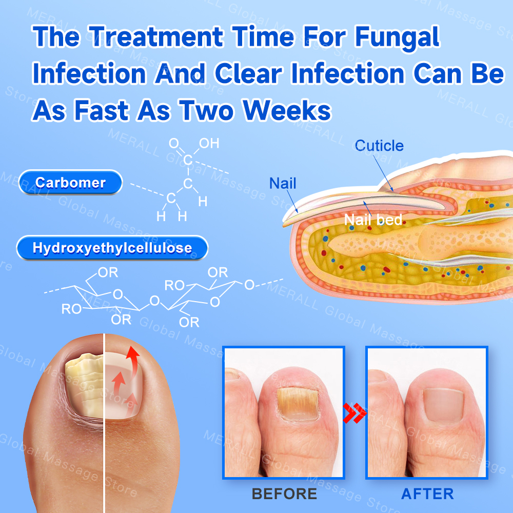 Fungal Nail Treatment Device Repair Fast Nails Fungus Onychomycosis Repair Toenail Fingernail Removes Nail Fungus Foot Care