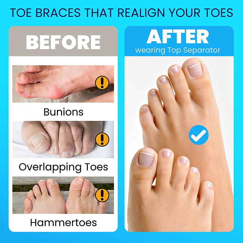 new Pexmen 2Pcs Toe Separator Spacers Toe Straightener Bunions and Restore Toes to Their Original Shape 2025 for Men and Women