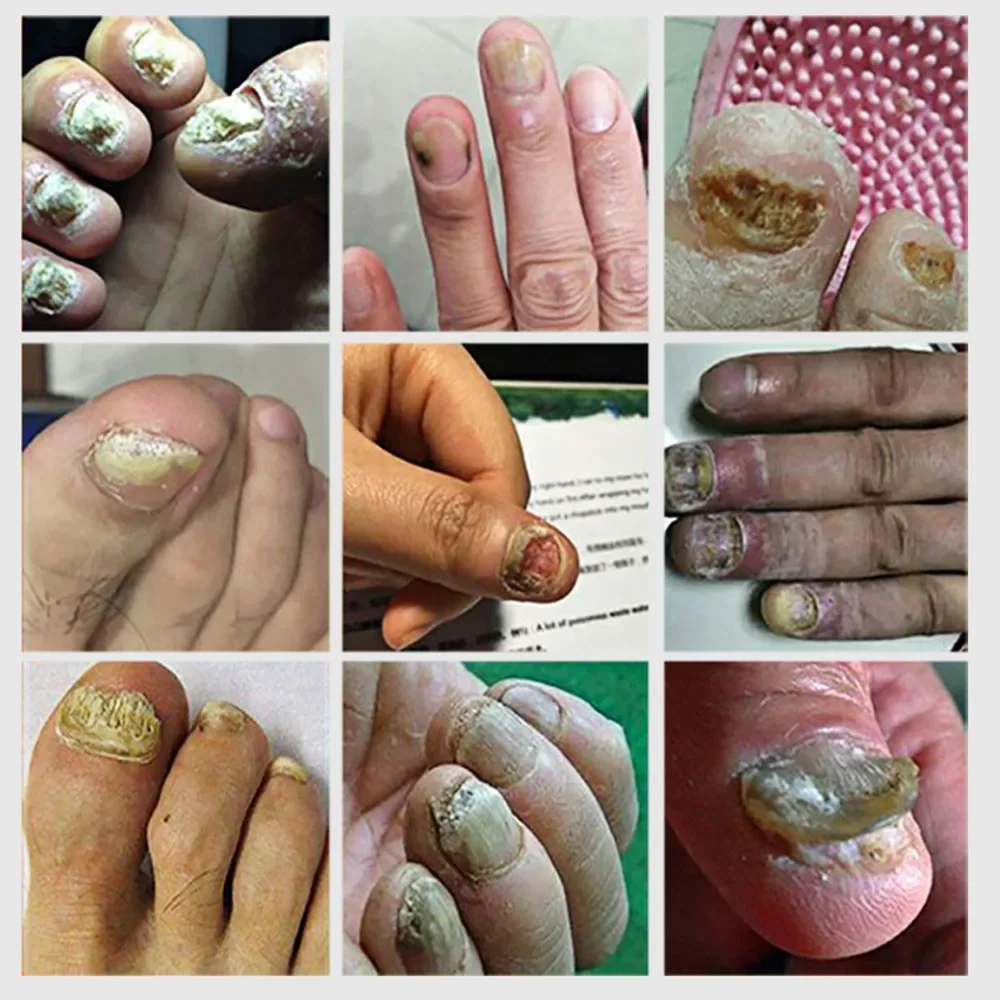 30ml Fungal Nail Treatment Essence Oil Nail Fungus Laser Device Repair Toenail Fingernail Treatment Onychomycosis with Mushrooms