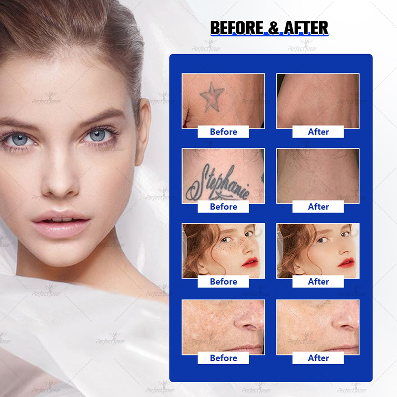 Perfectlaser New Q Switch Picolaser Nd Yag Laser Removal Tattoo Picosecond Machine Korea Picoseconed Equipment After-Sale Service