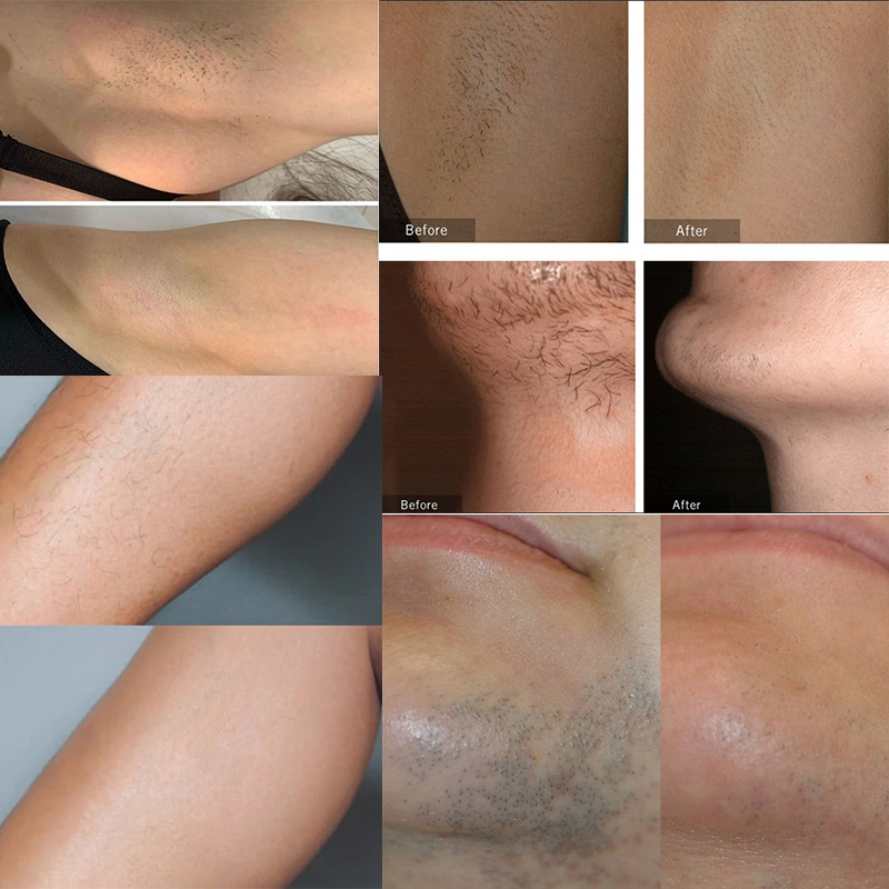 Ice Painless Laser Permanent Hair Remover LED Laser Hair Removal Machine 650~1300nm laser Diode Epilation Definitive