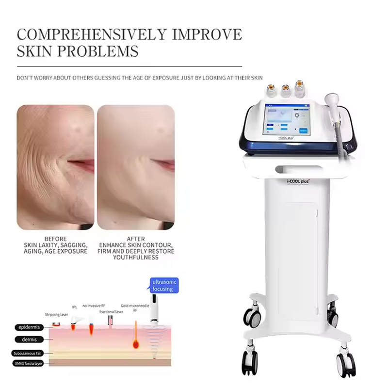 Body Contouring Smas Treatment Vmax Ultrasound Facial Y Corporal Radiofrecuencia Skin Firmness Machine