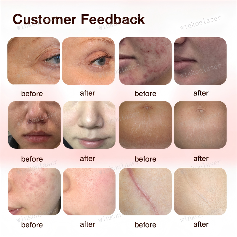 70W CO2 Fractional RF laser face resurfacing machine skin rejuvenation vaginal tightening 3IN1 beauty equipment