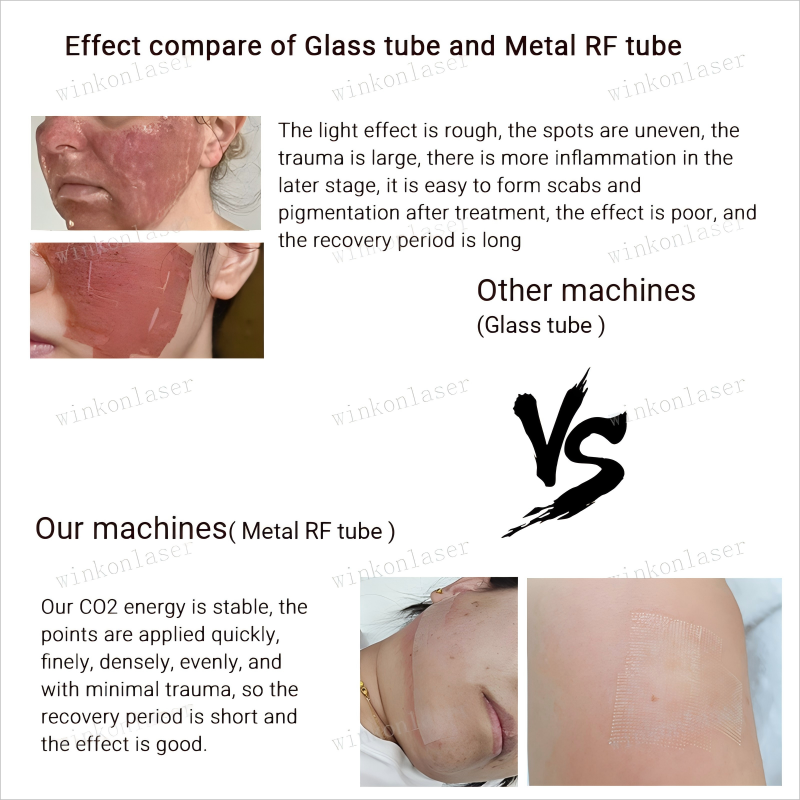 High quality CO2 Fractional RF laser face resurfacing machine scar removal vaginal tightening 3IN1 beauty equipment