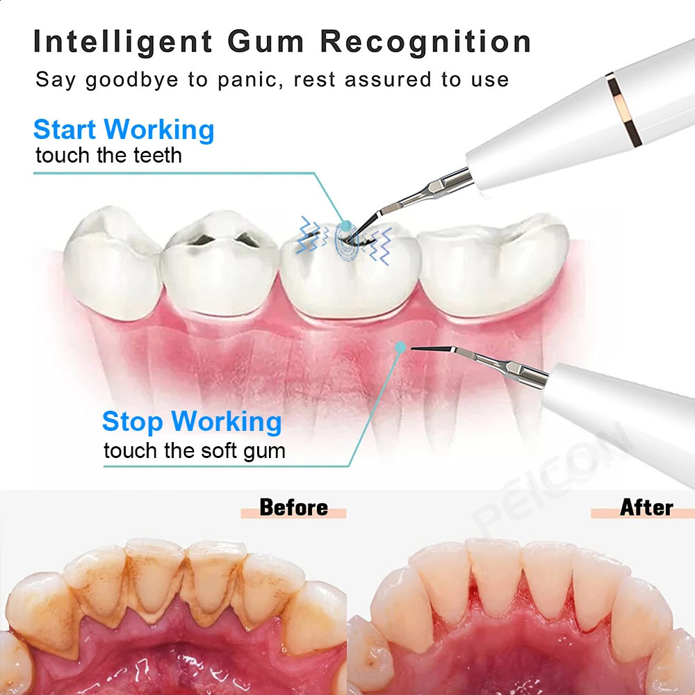 Ultrasonic Dental Tartar r Electric Ultra Sonic Dental Calculus r Plaque Removal Dental Tartar Eliminator 240701