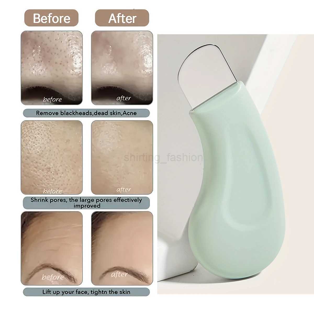 Blackhead and Whitehead Removal Tool for Nose and Face - Skin Pore Cleaner Skin Care Tools for WomenCL240708