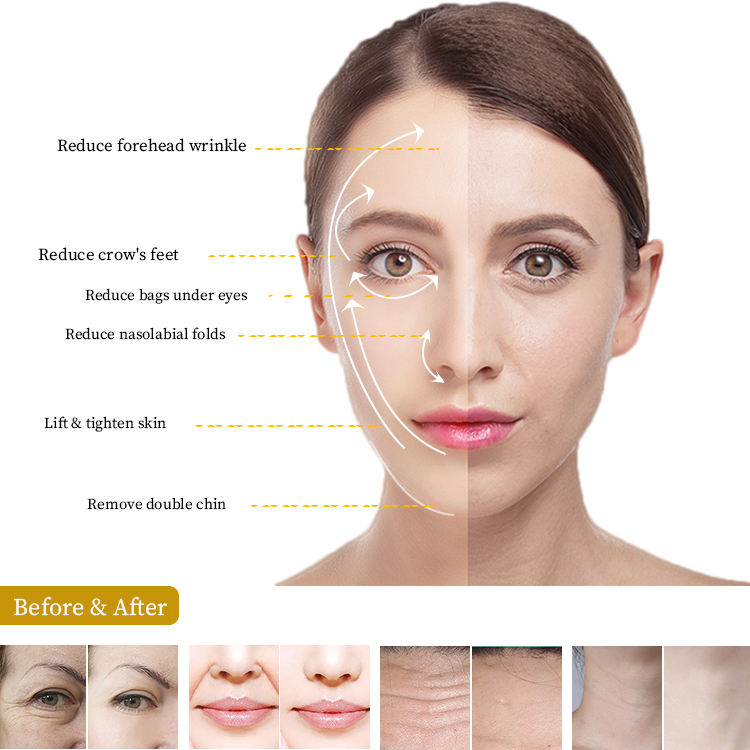 Multifunction 7D HIFU Face Remodeling Smas Skin Rejuvenation Wrinkle Removal Fine Line Improve Body Shaping Ultrasound Machine with 7 Cartridges