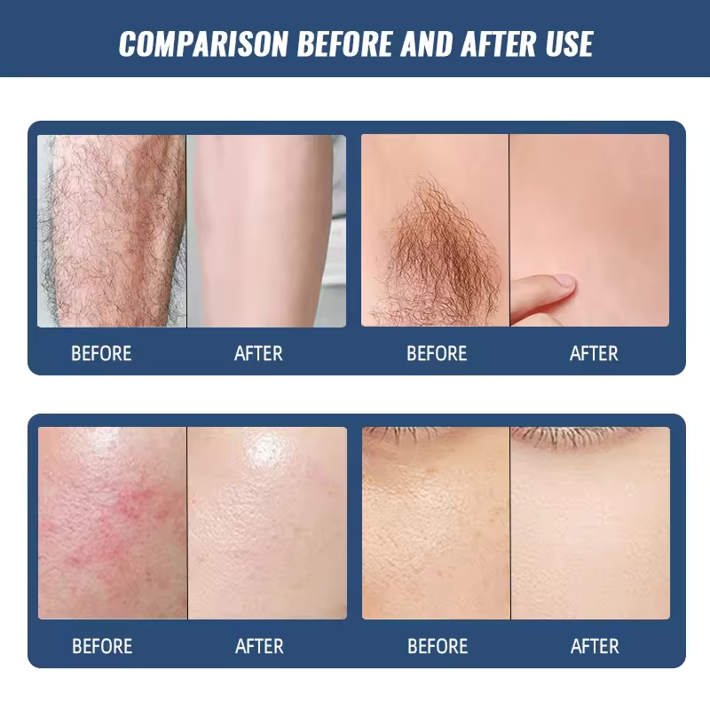 OPT hair removal machine IPL hair removal equipment Laser freezing point hair remove skin Rejuvenation machine