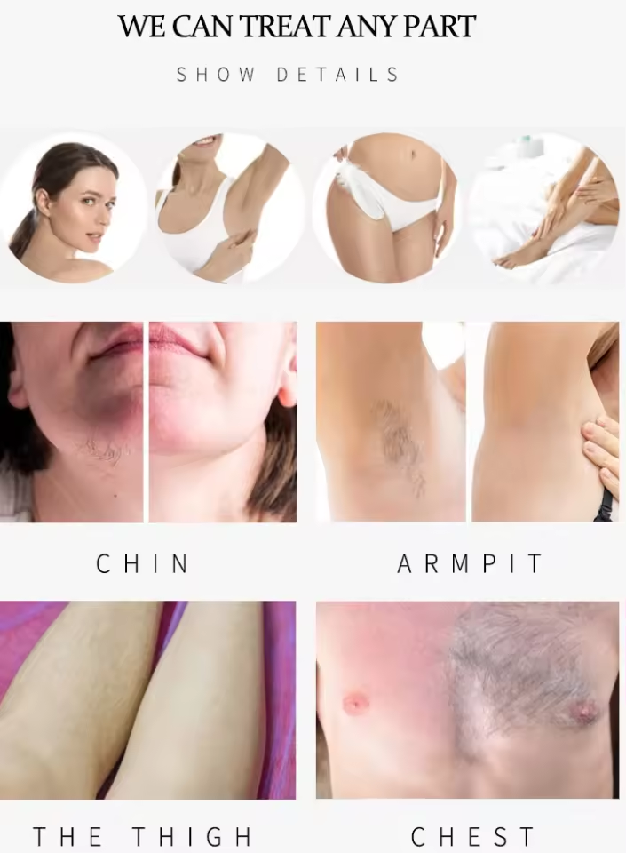 Powerful 808 Diode Laser Big Power Hair Removal Machine Laser Tattoo Removal Machine Nd Yag Q-switch Light-emitting Diode Vertical