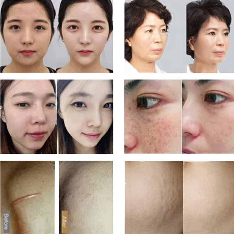 2Handles Rf Microneedle Machine +Ice Hammer Rf Skin Rejuvenation Face And Body Rf Treatment Prices For Sale For Salon