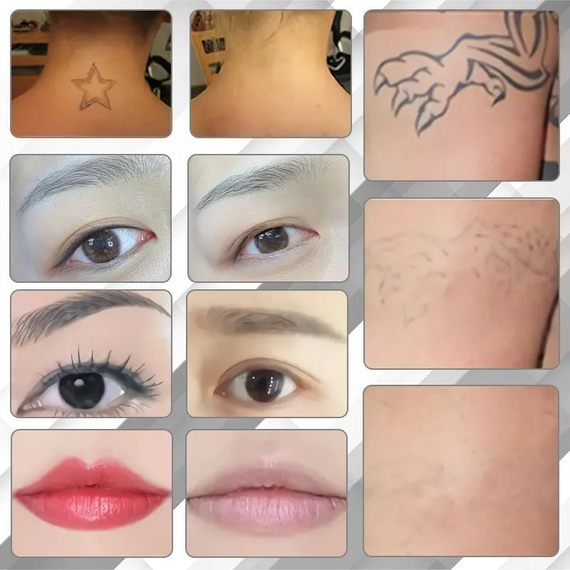 Portable Picosecond Laser 755nm Tattoo Removal Korea Nd Yag Remove Pigment Freckle Non-invasive Beauty Machine With CE