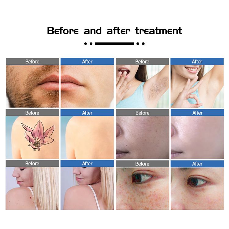 Hot Selling laser Resurfacing hair Removal Device Tattoo Removal Multifunction Machine