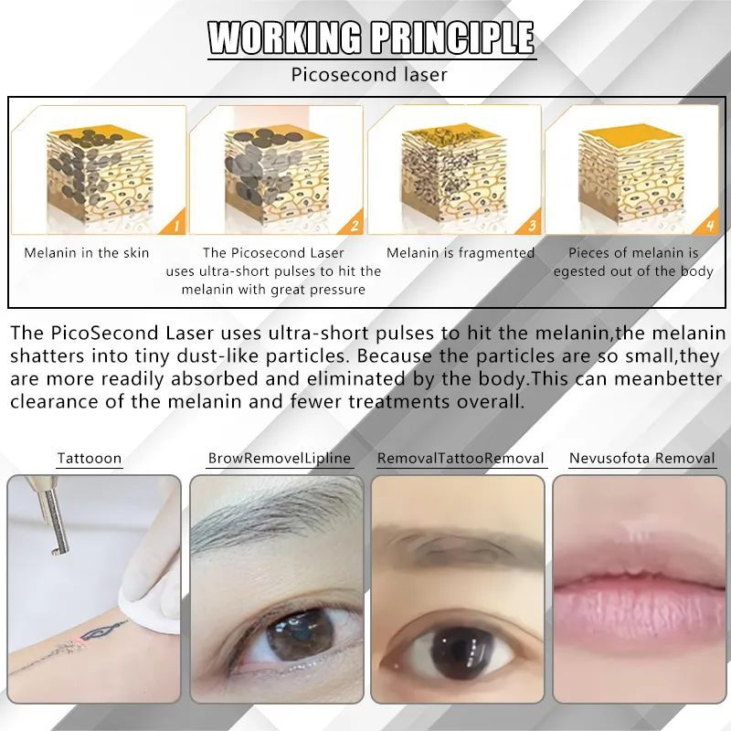 Portable Picosecond Laser 755nm Tattoo Removal Korea Nd Yag Remove Pigment Freckle Non-invasive Beauty Machine With CE