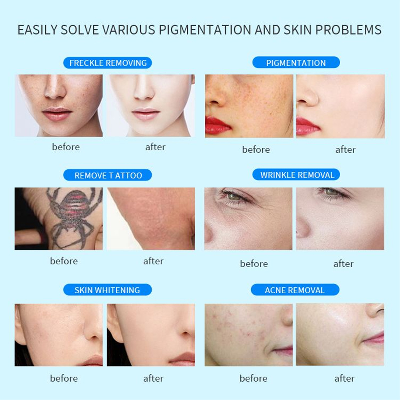 Beauty Salon Supplies Anti Acne Freckles Face Care Eyebrow Washing Skin Rejuvenation Moles Scars Remover Picosecond Laser Tattoo Removal Spa Machine