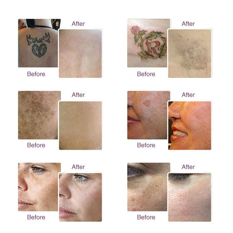 Laser Eyebrow Washing Nd Yag Q Switch Vertical Picosecond Laser Tattoo Removal Honeycomb Peel Head 755nm Pigment Remover Skin Rejuvenation Machine