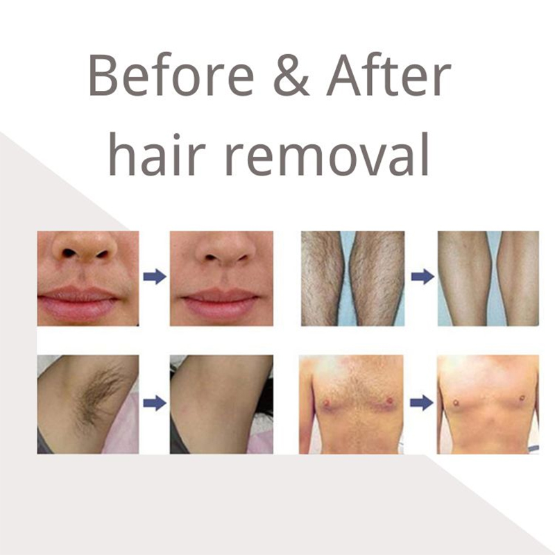 Laser Professional 2 In 1 Fast Nd Yag Laser Tattoo Removal 808 Hair Removal Diode Laser CE Approved Machine For Commercial Beaut