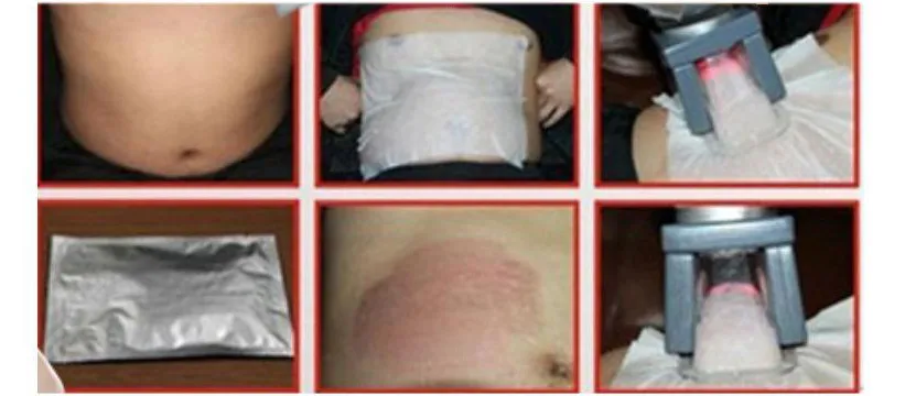 Antifreeze Membrane Antifreezing Anti-freezing Pad 3 Size for Cryo Therapy Cryolipolysis Fat Freezing Machine Anti Freezing Membrane