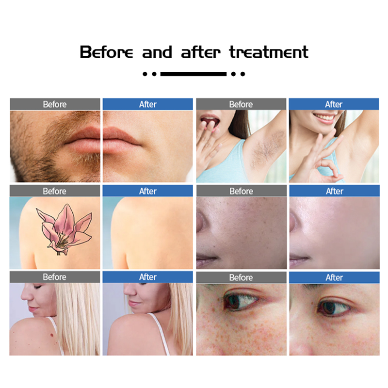 Hot Sale 2 Handles Pico Laser Tattoo Removal Diode Laser 810 Diode Laser Hair Removal Beauty Device Skin Rejuvenation Washing Eyebrows Beauty Machine