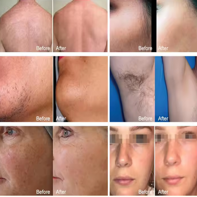 HOT Selling Freezing Cooling System 808 Fast Hair Removal Device Salon Home Use Small China Diode Laser with Good Effect