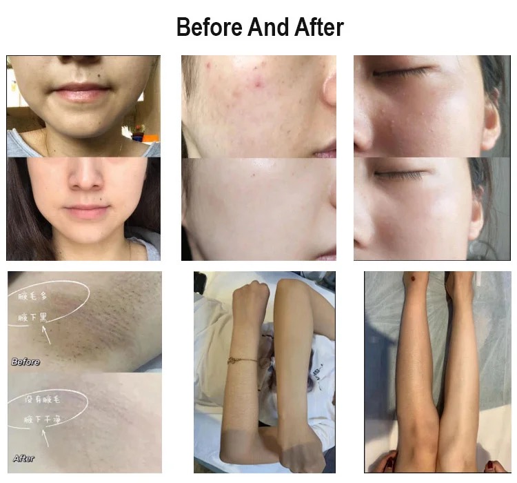 2024 Professional 2 in 1 Diode Laser 3 Wavelengths 755 808 1064Nm Permanent Diode Laser Hair Removal Machine
